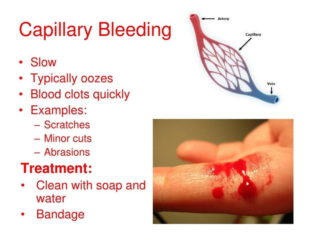capillary bleeding
