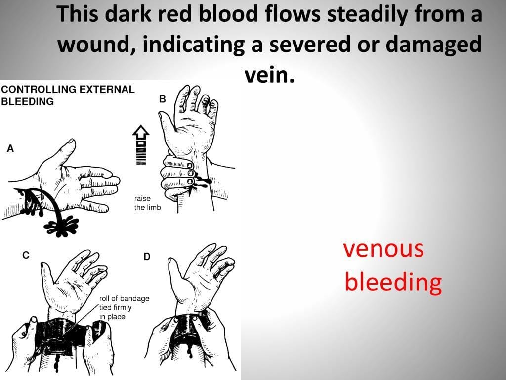Arterial Bleeding